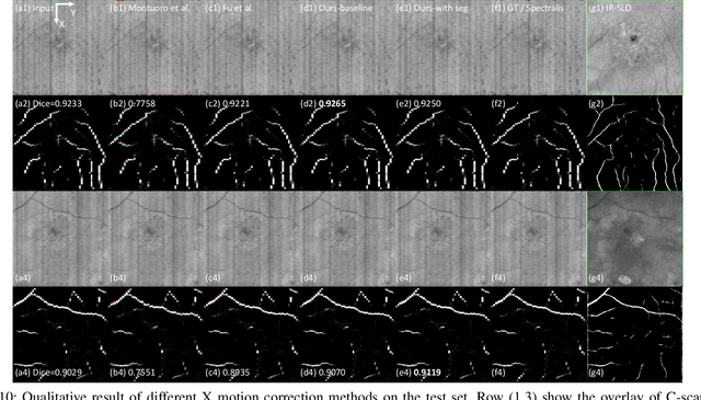Figure 3 for Deep learning network to correct axial and coronal eye motion in 3D OCT retinal imaging