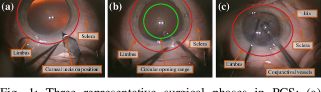 Figure 1 for Phase-Specific Augmented Reality Guidance for Microscopic Cataract Surgery Using Long-Short Spatiotemporal Aggregation Transformer