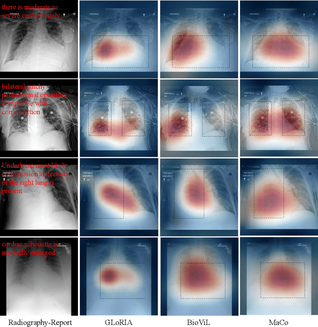 Figure 4 for Enhancing Representation in Radiography-Reports Foundation Model: A Granular Alignment Algorithm Using Masked Contrastive Learning