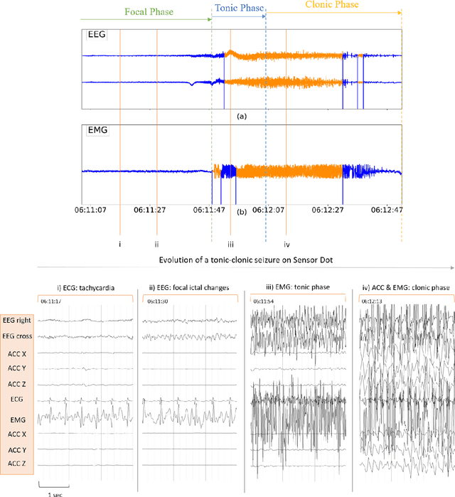 Figure 3 for Multimodal wearable EEG, EMG and accelerometry measurements improve the accuracy of tonic-clonic seizure detection in-hospital