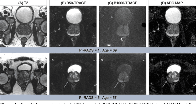 Figure 2 for FastMRI Prostate: A Publicly Available, Biparametric MRI Dataset to Advance Machine Learning for Prostate Cancer Imaging