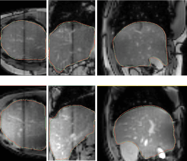 Figure 4 for End-to-end Deformable Attention Graph Neural Network for Single-view Liver Mesh Reconstruction