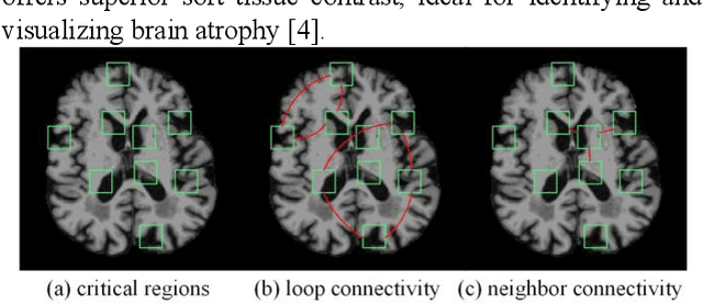 Figure 1 for Adaptive Critical Subgraph Mining for Cognitive Impairment Conversion Prediction with T1-MRI-based Brain Network