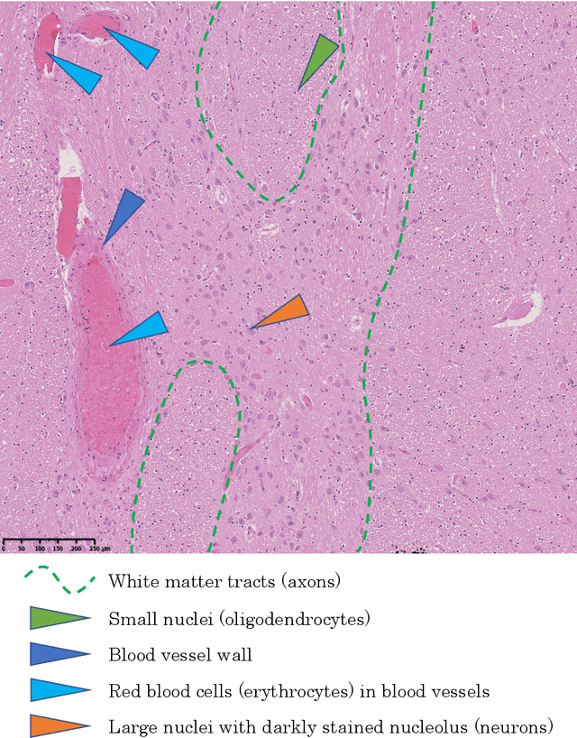 Figure 2 for Computational Pathology for Brain Disorders
