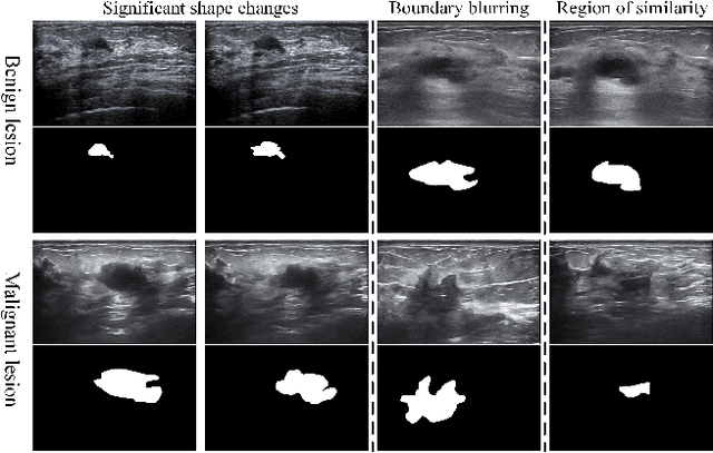 Figure 1 for A Spatial-Temporal Progressive Fusion Network for Breast Lesion Segmentation in Ultrasound Videos