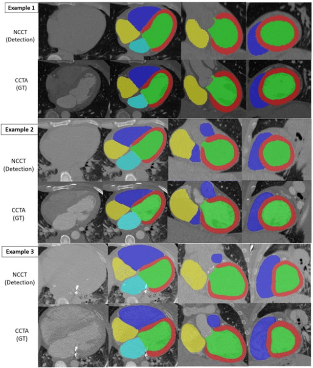 Figure 3 for AI-based, automated chamber volumetry from gated, non-contrast CT