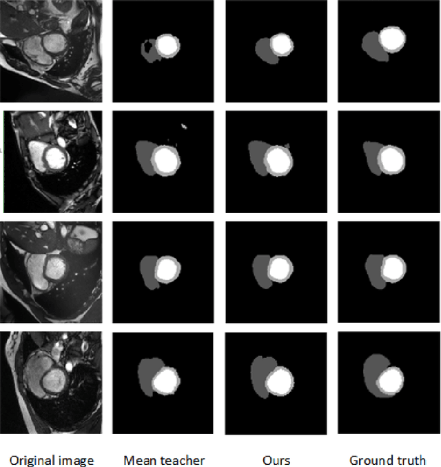 Figure 4 for Self-training with dual uncertainty for semi-supervised medical image segmentation