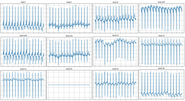 Figure 1 for Deep conv-attention model for diagnosing left bundle branch block from 12-lead electrocardiograms