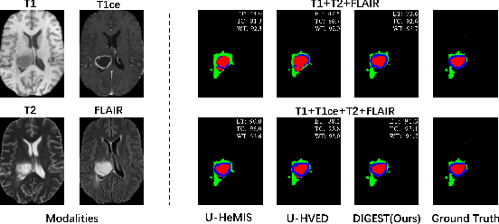 Figure 3 for DIGEST: Deeply supervIsed knowledGE tranSfer neTwork learning for brain tumor segmentation with incomplete multi-modal MRI scans