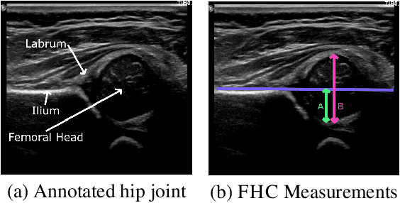 Figure 1 for Infant hip screening using multi-class ultrasound scan segmentation