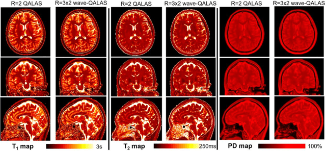 Figure 3 for Time-efficient, High Resolution 3T Whole Brain Quantitative Relaxometry using 3D-QALAS with Wave-CAIPI Readouts
