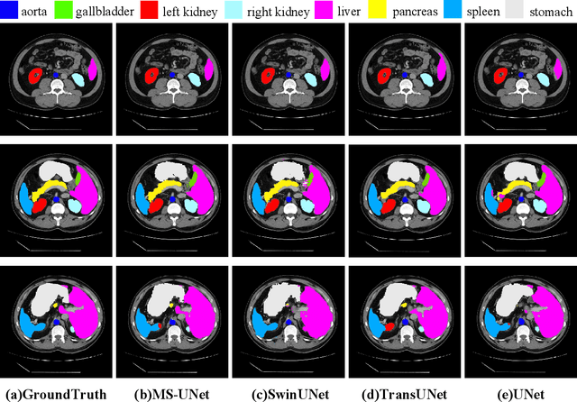 Figure 1 for MS-UNet-v2: Adaptive Denoising Method and Training Strategy for Medical Image Segmentation with Small Training Data