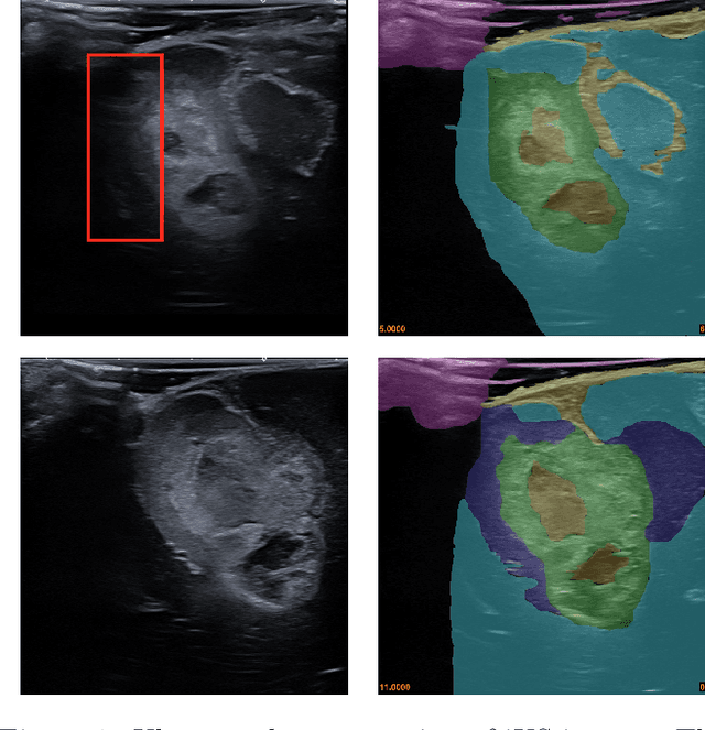 Figure 1 for Identifying Visible Tissue in Intraoperative Ultrasound Images during Brain Surgery: A Method and Application