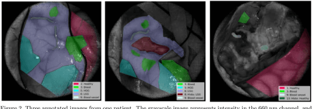 Figure 3 for Intra-operative Brain Tumor Detection with Deep Learning-Optimized Hyperspectral Imaging