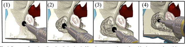 Figure 4 for Improving Surgical Situational Awareness with Signed Distance Field: A Pilot Study in Virtual Reality