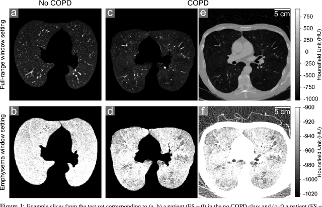 Figure 1 for Optimizing Convolutional Neural Networks for Chronic Obstructive Pulmonary Disease Detection in Clinical Computed Tomography Imaging
