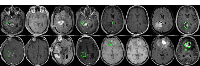 Figure 1 for Segmentation of glioblastomas in early post-operative multi-modal MRI with deep neural networks