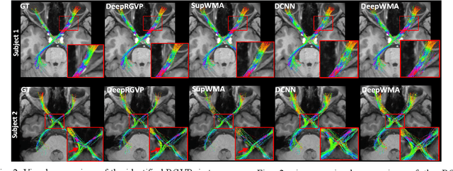 Figure 3 for DeepRGVP: A Novel Microstructure-Informed Supervised Contrastive Learning Framework for Automated Identification Of The Retinogeniculate Pathway Using dMRI Tractography