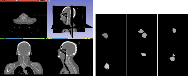 Figure 3 for Feature Gradient Flow for Interpreting Deep Neural Networks in Head and Neck Cancer Prediction