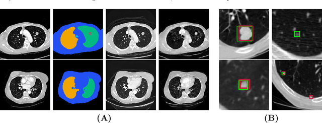 Figure 2 for High-Fidelity Image Synthesis from Pulmonary Nodule Lesion Maps using Semantic Diffusion Model
