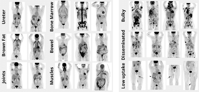 Figure 1 for Whole-body tumor segmentation of 18F -FDG PET/CT using a cascaded and ensembled convolutional neural networks