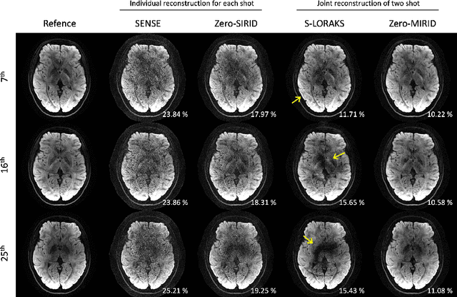 Figure 3 for Improved Multi-Shot Diffusion-Weighted MRI with Zero-Shot Self-Supervised Learning Reconstruction