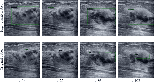 Figure 2 for Mining Negative Temporal Contexts For False Positive Suppression In Real-Time Ultrasound Lesion Detection