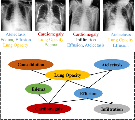 Figure 1 for BB-GCN: A Bi-modal Bridged Graph Convolutional Network for Multi-label Chest X-Ray Recognition