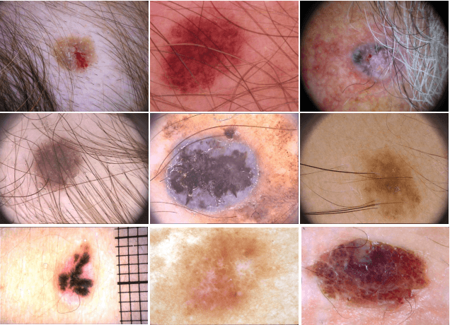 Figure 1 for Multi-task Explainable Skin Lesion Classification
