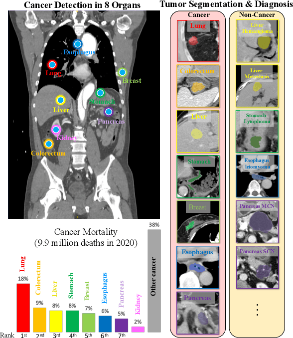 Figure 1 for Towards a Single Unified Model for Effective Detection, Segmentation, and Diagnosis of Eight Major Cancers Using a Large Collection of CT Scans