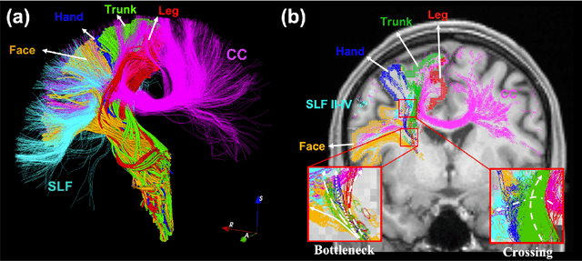 Figure 3 for Reconstructing the somatotopic organization of the corticospinal tract remains a challenge for modern tractography methods