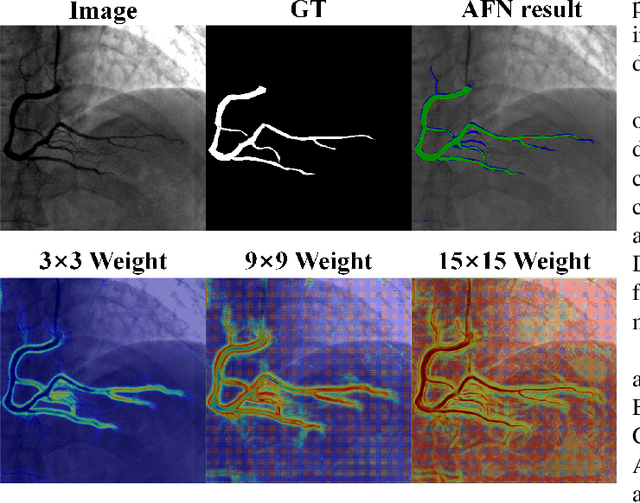 Figure 4 for Affinity Feature Strengthening for Accurate, Complete and Robust Vessel Segmentation