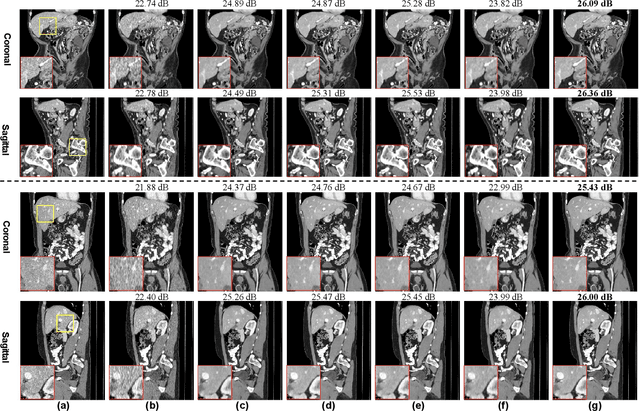 Figure 4 for LIT-Former: Linking In-plane and Through-plane Transformers for Simultaneous CT Image Denoising and Deblurring