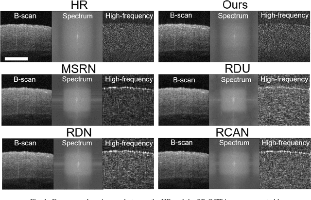 Figure 1 for Frequency-aware optical coherence tomography image super-resolution via conditional generative adversarial neural network