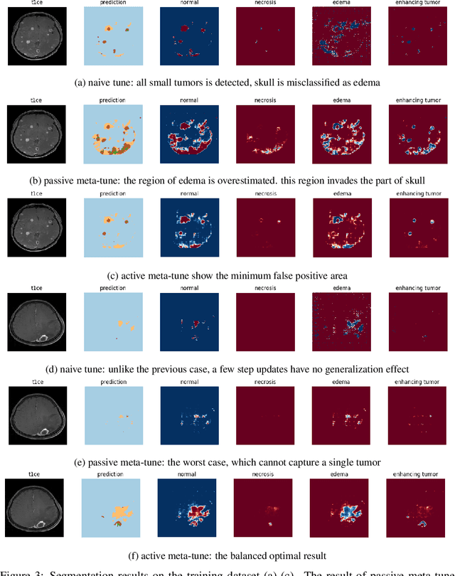 Figure 2 for Learning to Learn Unlearned Feature for Brain Tumor Segmentation