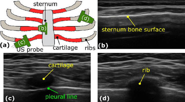 Figure 1 for Skeleton Graph-based Ultrasound-CT Non-rigid Registration