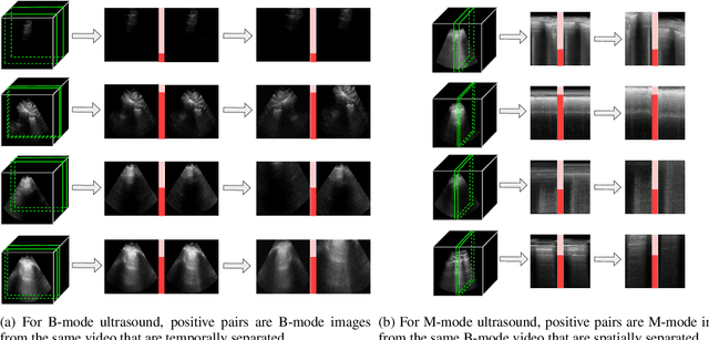 Figure 1 for Intra-video Positive Pairs in Self-Supervised Learning for Ultrasound
