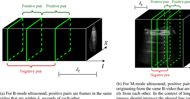 Figure 3 for Intra-video Positive Pairs in Self-Supervised Learning for Ultrasound