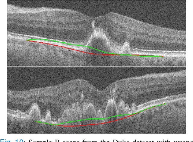 Figure 2 for Segmentation of Bruch's Membrane in retinal OCT with AMD using anatomical priors and uncertainty quantification