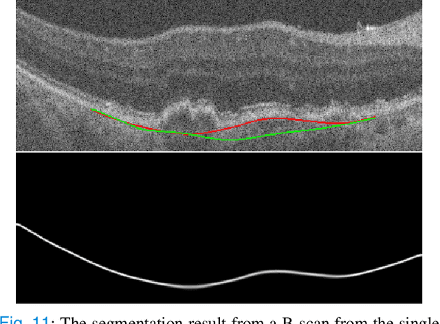 Figure 3 for Segmentation of Bruch's Membrane in retinal OCT with AMD using anatomical priors and uncertainty quantification