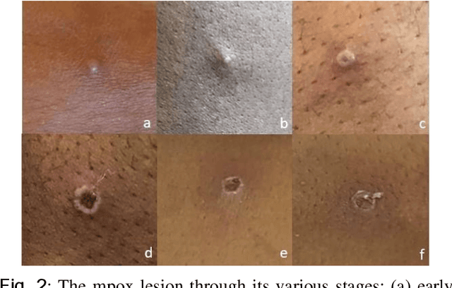 Figure 3 for A Web-based Mpox Skin Lesion Detection System Using State-of-the-art Deep Learning Models Considering Racial Diversity