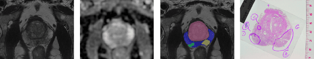 Figure 4 for ProstAttention-Net: A deep attention model for prostate cancer segmentation by aggressiveness in MRI scans