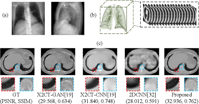 Figure 1 for SdCT-GAN: Reconstructing CT from Biplanar X-Rays with Self-driven Generative Adversarial Networks