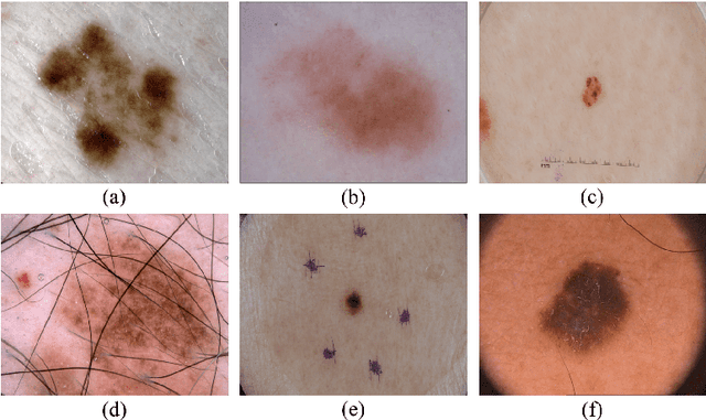 Figure 1 for LCAUnet: A skin lesion segmentation network with enhanced edge and body fusion