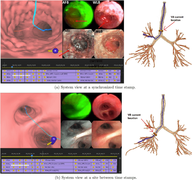Figure 3 for Bronchoscopic video synchronization for interactive multimodal inspection of bronchial lesions