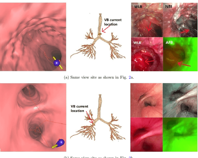 Figure 4 for Bronchoscopic video synchronization for interactive multimodal inspection of bronchial lesions