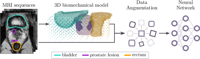 Figure 1 for Anatomy-informed Data Augmentation for Enhanced Prostate Cancer Detection