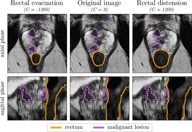 Figure 3 for Anatomy-informed Data Augmentation for Enhanced Prostate Cancer Detection