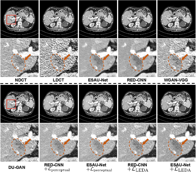 Figure 4 for Low-dose CT Denoising with Language-engaged Dual-space Alignment