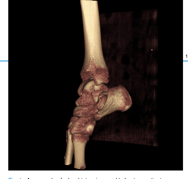 Figure 1 for A multi-stage semi-supervised learning for ankle fracture classification on CT images